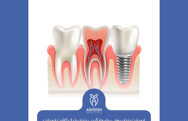 ایمپلنت دندان روشی برای جایگزینی دندان با یک کاشت ایمپلنت